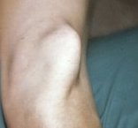 Photo of a dislocated kneecap, in case you really want to see one